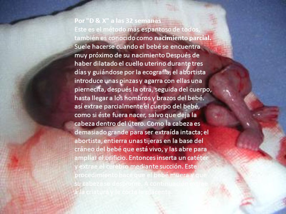 Por D & X a las 32 semanas Este es el método más espantoso de todos, también es conocido como nacimiento parcial.