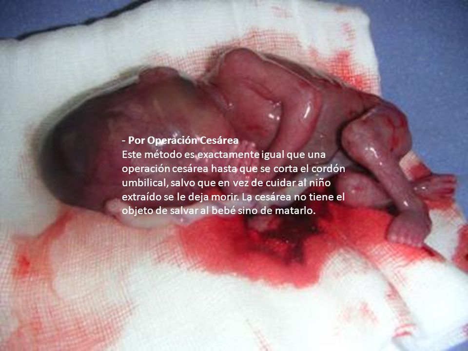 - Por Operación Cesárea Este método es exactamente igual que una operación cesárea hasta que se corta el cordón umbilical, salvo que en vez de cuidar al niño extraído se le deja morir.