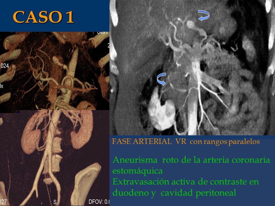CASO 1 Aneurisma roto de la arteria coronaria estomáquica