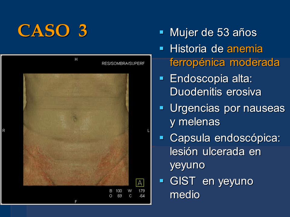 CASO 3 Mujer de 53 años Historia de anemia ferropénica moderada