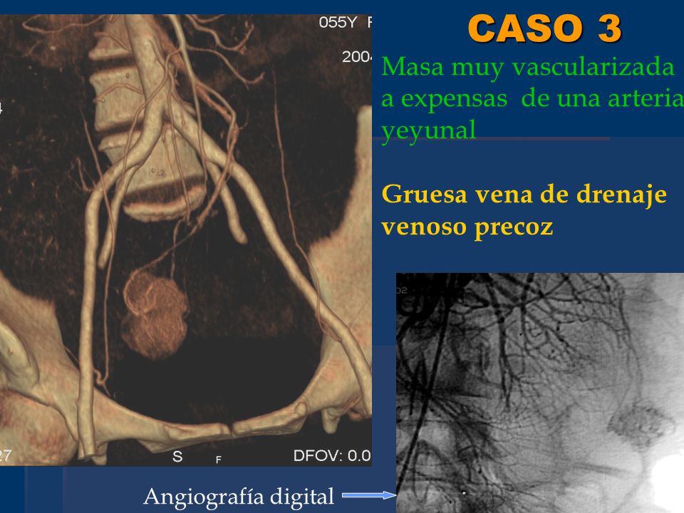 CASO 3 Masa muy vascularizada a expensas de una arteria yeyunal