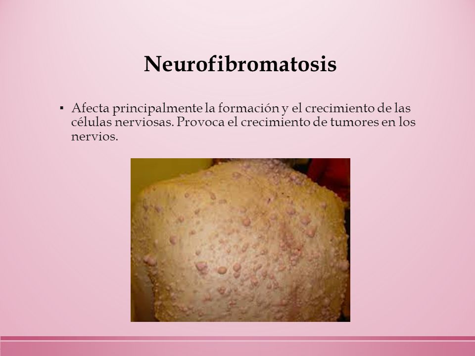 Neurofibromatosis Afecta principalmente la formación y el crecimiento de las células nerviosas.