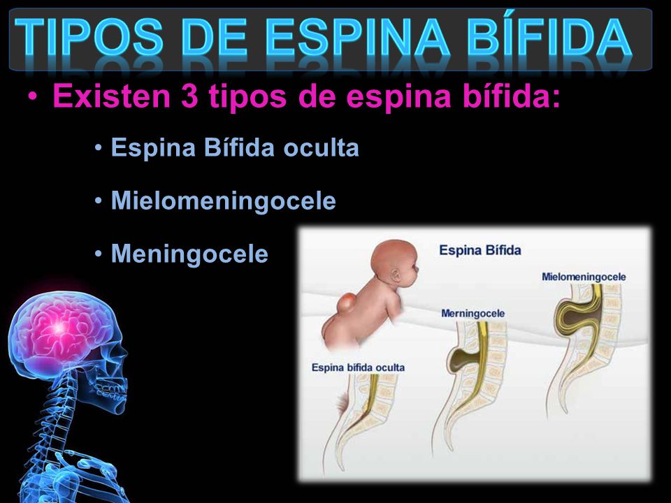 Tipos de Espina Bífida Existen 3 tipos de espina bífida: