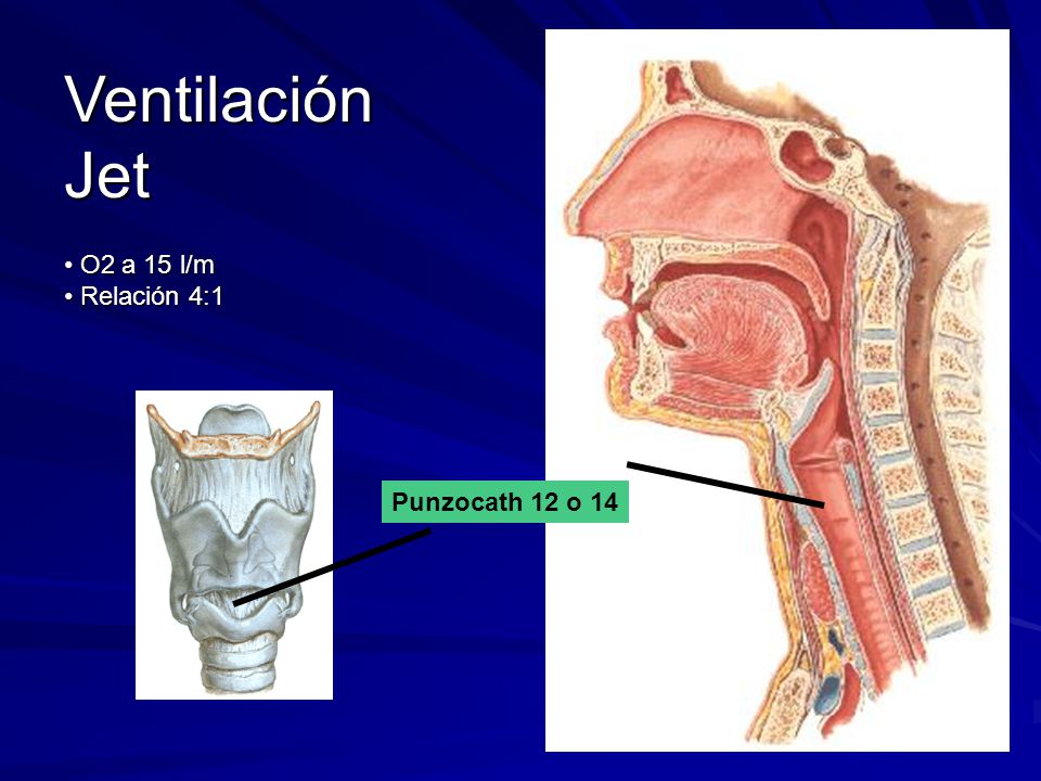 Ventilación Jet O2 a 15 l/m Relación 4:1 Punzocath 12 o 14