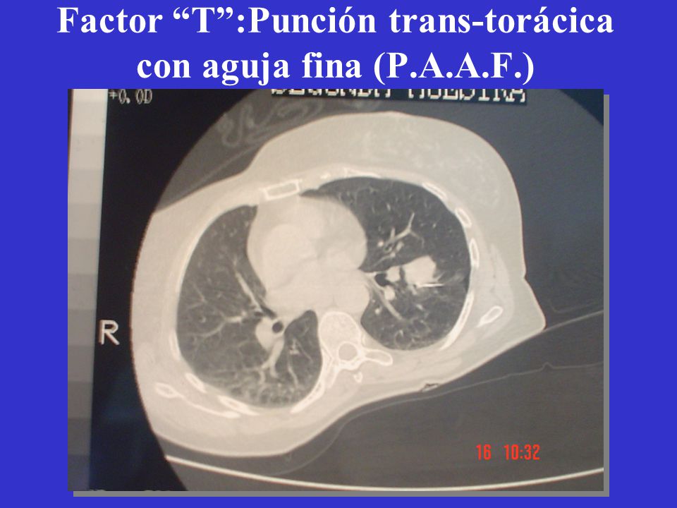 Factor T :Punción trans-torácica con aguja fina (P.A.A.F.)