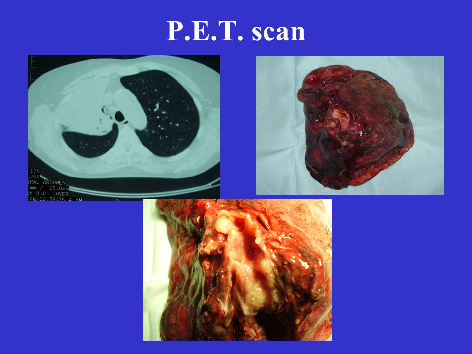 P.E.T. scan