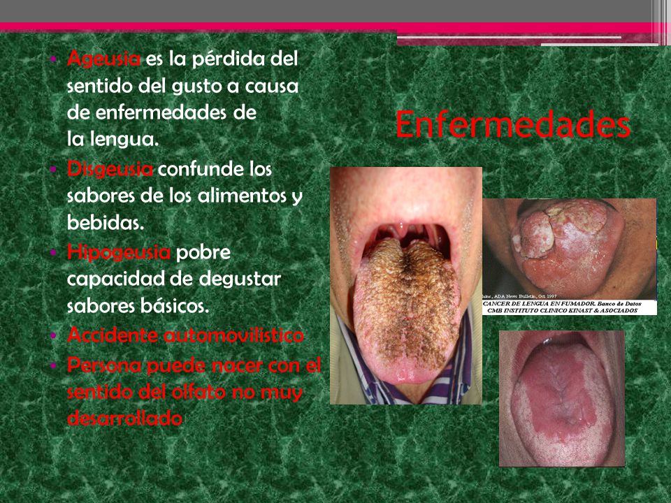 Ageusia es la pérdida del sentido del gusto a causa de enfermedades de la lengua.