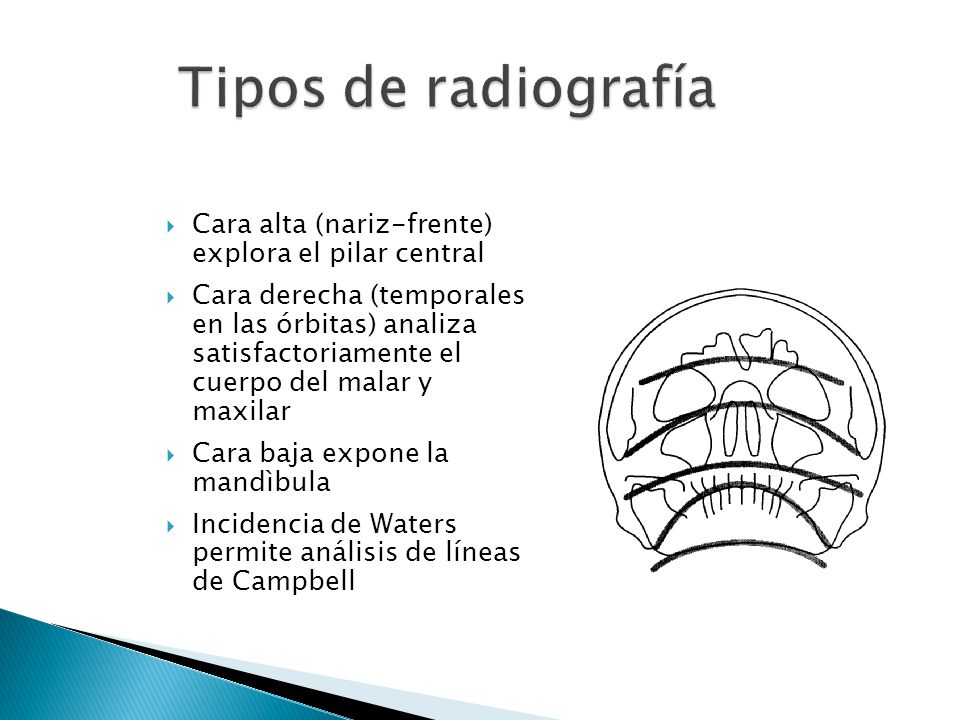 Tipos de radiografía Cara alta (nariz-frente) explora el pilar central