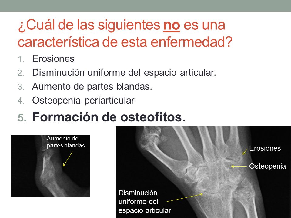 ¿Cuál de las siguientes no es una característica de esta enfermedad