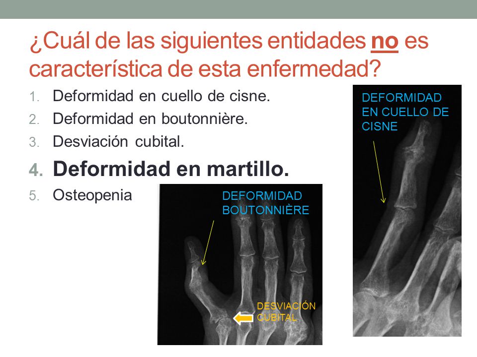 ¿Cuál de las siguientes entidades no es característica de esta enfermedad