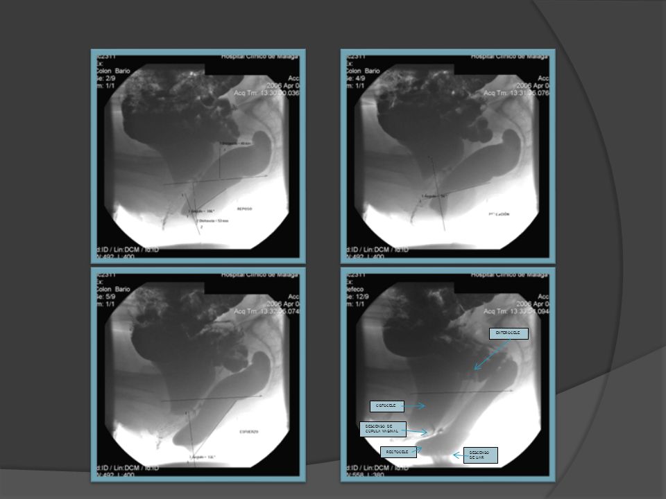 RECTOCELE CISTOCELE DESCENSO DE CÚPULA VAGINAL DESCENSO DE UAR ENTEROCELE