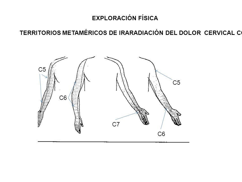 EXPLORACIÓN FÍSICA TERRITORIOS METAMÉRICOS DE IRARADIACIÓN DEL DOLOR CERVICAL COMPRESIVO. C5. C5.