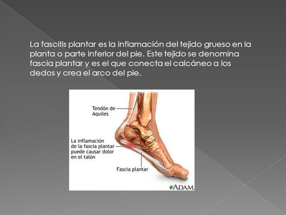 La fascitis plantar es la inflamación del tejido grueso en la planta o parte inferior del pie.