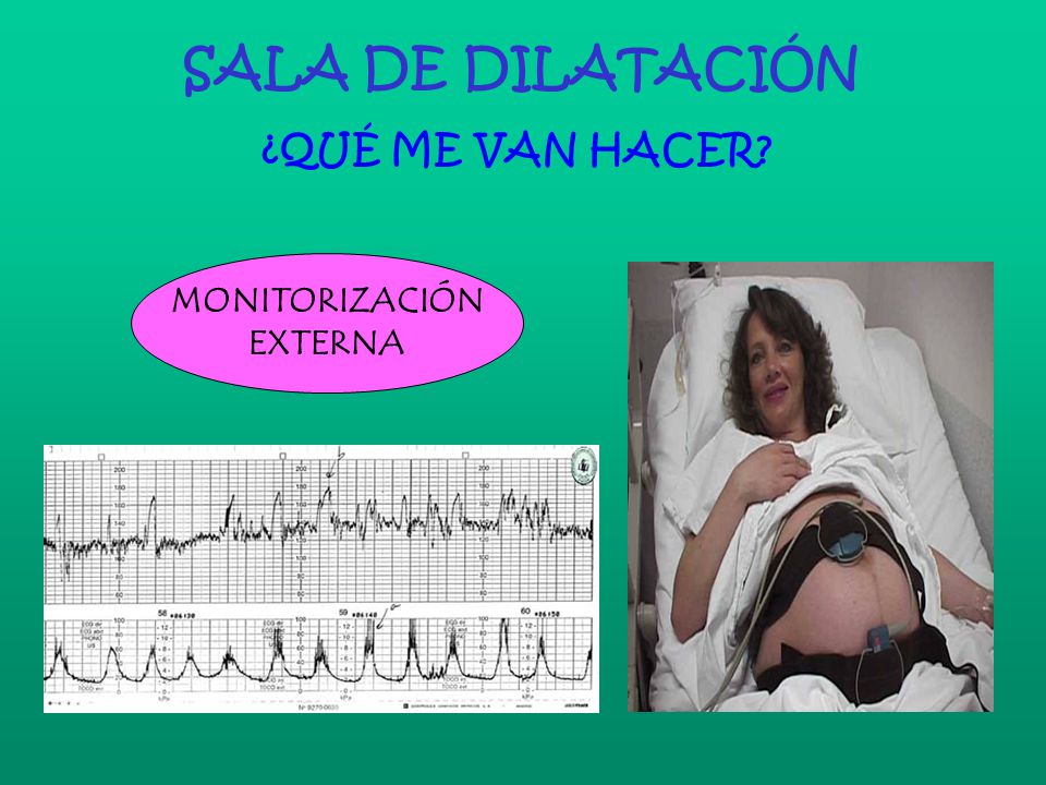 SALA DE DILATACIÓN ¿QUÉ ME VAN HACER MONITORIZACIÓN EXTERNA