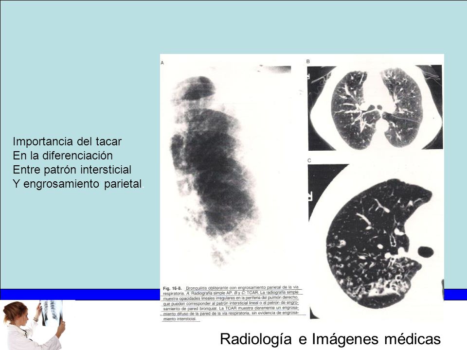 Importancia del tacar En la diferenciación Entre patrón intersticial Y engrosamiento parietal.