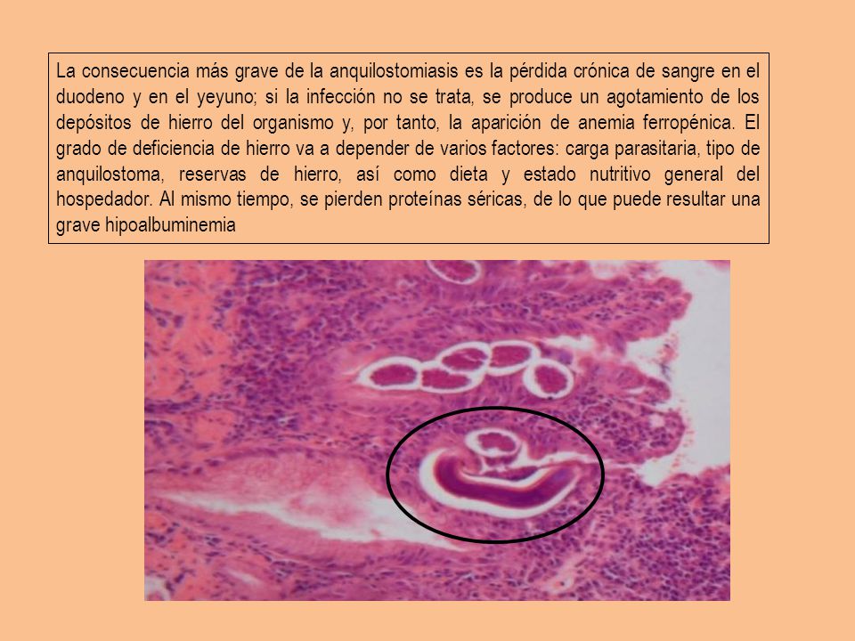 La consecuencia más grave de la anquilostomiasis es la pérdida crónica de sangre en el duodeno y en el yeyuno; si la infección no se trata, se produce un agotamiento de los depósitos de hierro del organismo y, por tanto, la aparición de anemia ferropénica.