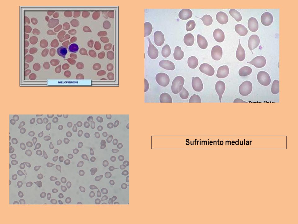 Sufrimiento medular