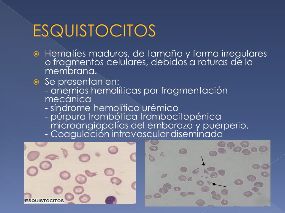 ESQUISTOCITOS Hematíes maduros, de tamaño y forma irregulares o fragmentos celulares, debidos a roturas de la membrana.