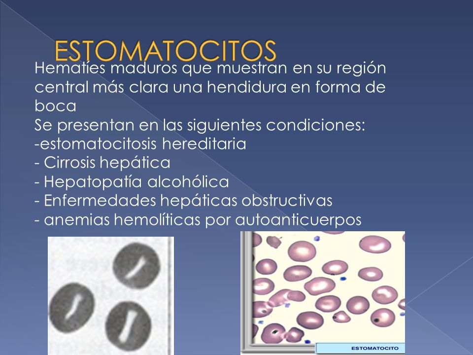 ESTOMATOCITOS Hematíes maduros que muestran en su región central más clara una hendidura en forma de boca.