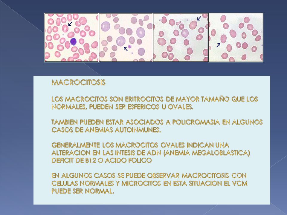 MACROCITOSIS LOS MACROCITOS SON ERITROCITOS DE MAYOR TAMAÑO QUE LOS NORMALES, PUEDEN SER ESFERICOS U OVALES.