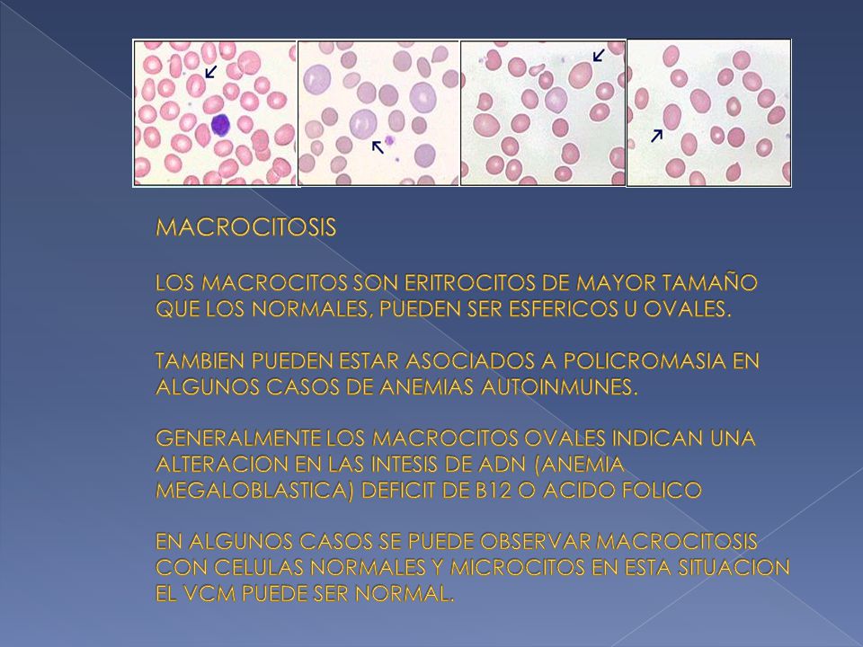 MACROCITOSIS LOS MACROCITOS SON ERITROCITOS DE MAYOR TAMAÑO QUE LOS NORMALES, PUEDEN SER ESFERICOS U OVALES.