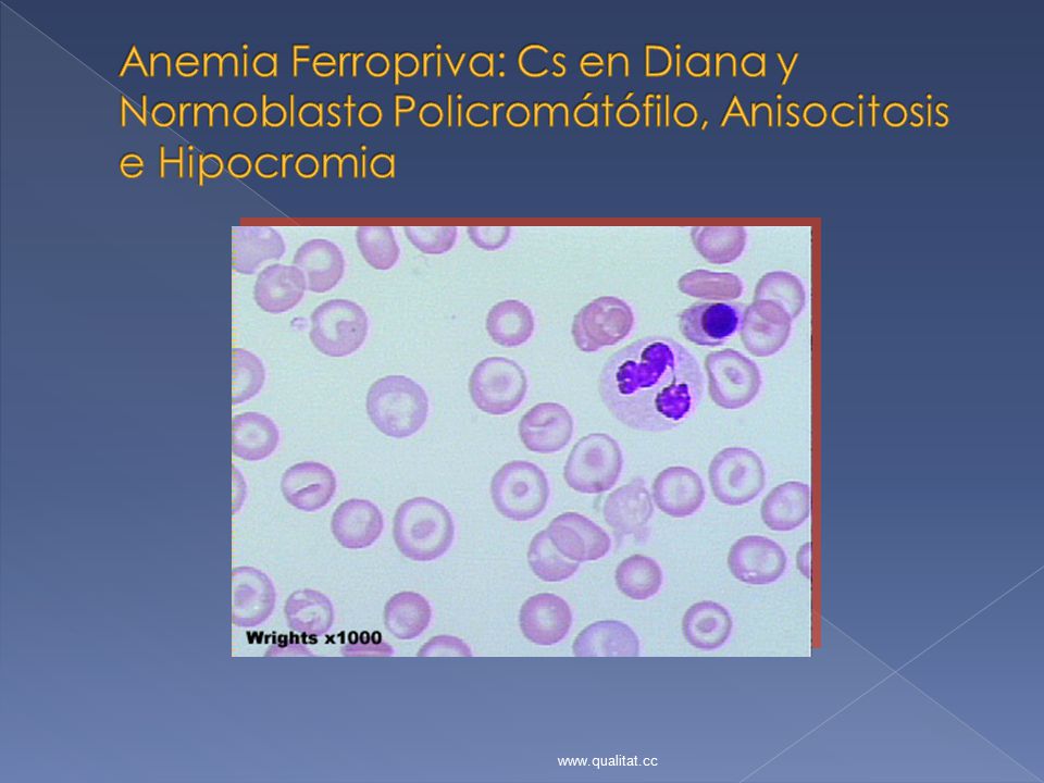 Anemia Ferropriva: Cs en Diana y Normoblasto Policromátófilo, Anisocitosis e Hipocromia