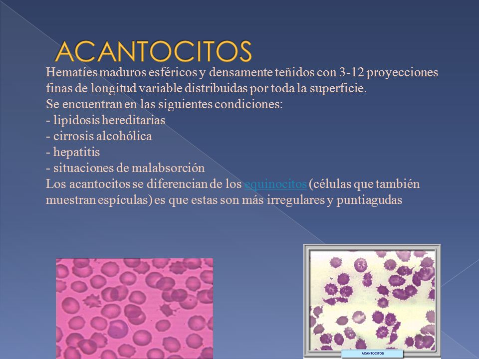 ACANTOCITOS Hematíes maduros esféricos y densamente teñidos con 3-12 proyecciones finas de longitud variable distribuidas por toda la superficie.