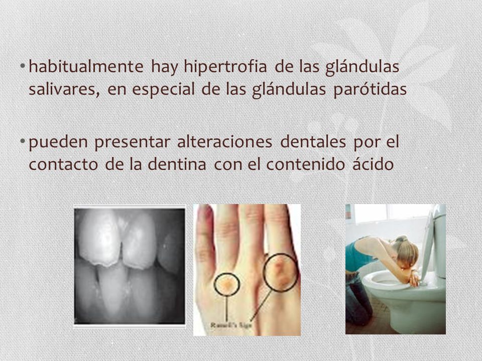 habitualmente hay hipertrofia de las glándulas salivares, en especial de las glándulas parótidas