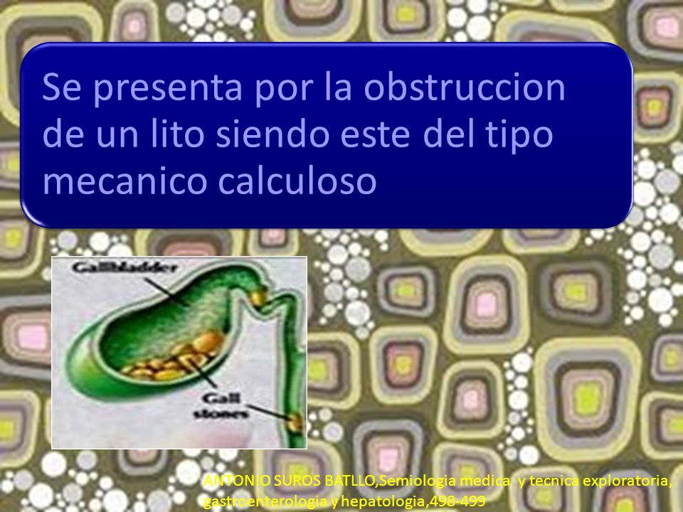 Se presenta por la obstruccion de un lito siendo este del tipo mecanico calculoso