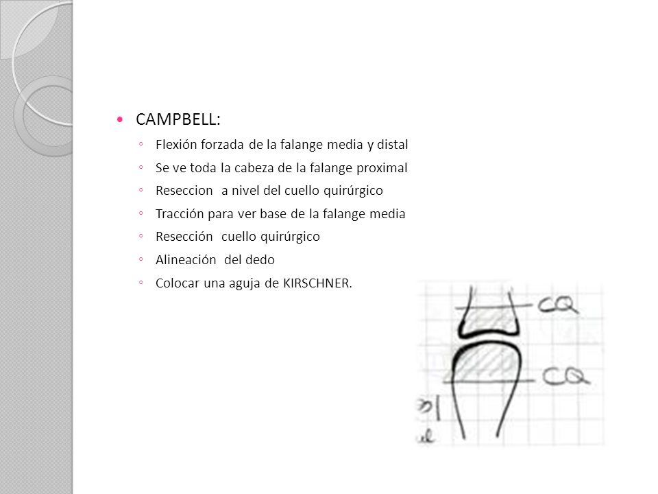 CAMPBELL: Flexión forzada de la falange media y distal