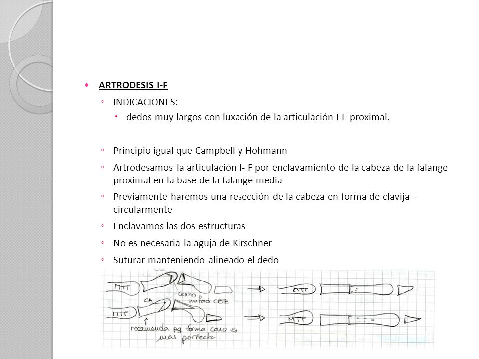 ARTRODESIS I-F INDICACIONES: dedos muy largos con luxación de la articulación I-F proximal. Principio igual que Campbell y Hohmann.