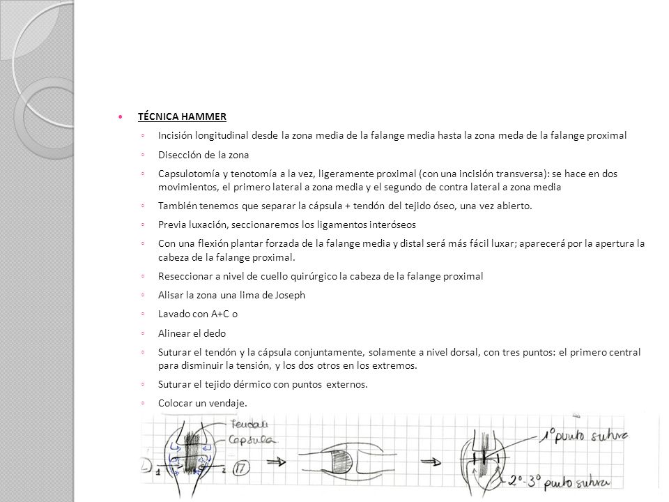 TÉCNICA HAMMER Incisión longitudinal desde la zona media de la falange media hasta la zona meda de la falange proximal.