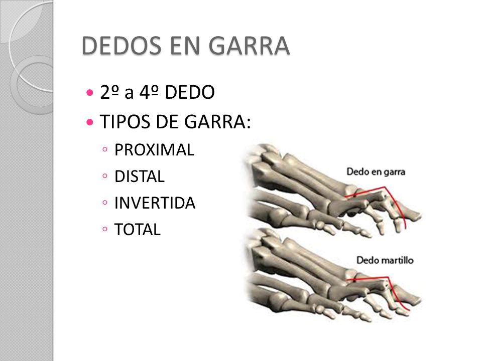 DEDOS EN GARRA 2º a 4º DEDO TIPOS DE GARRA: PROXIMAL DISTAL INVERTIDA