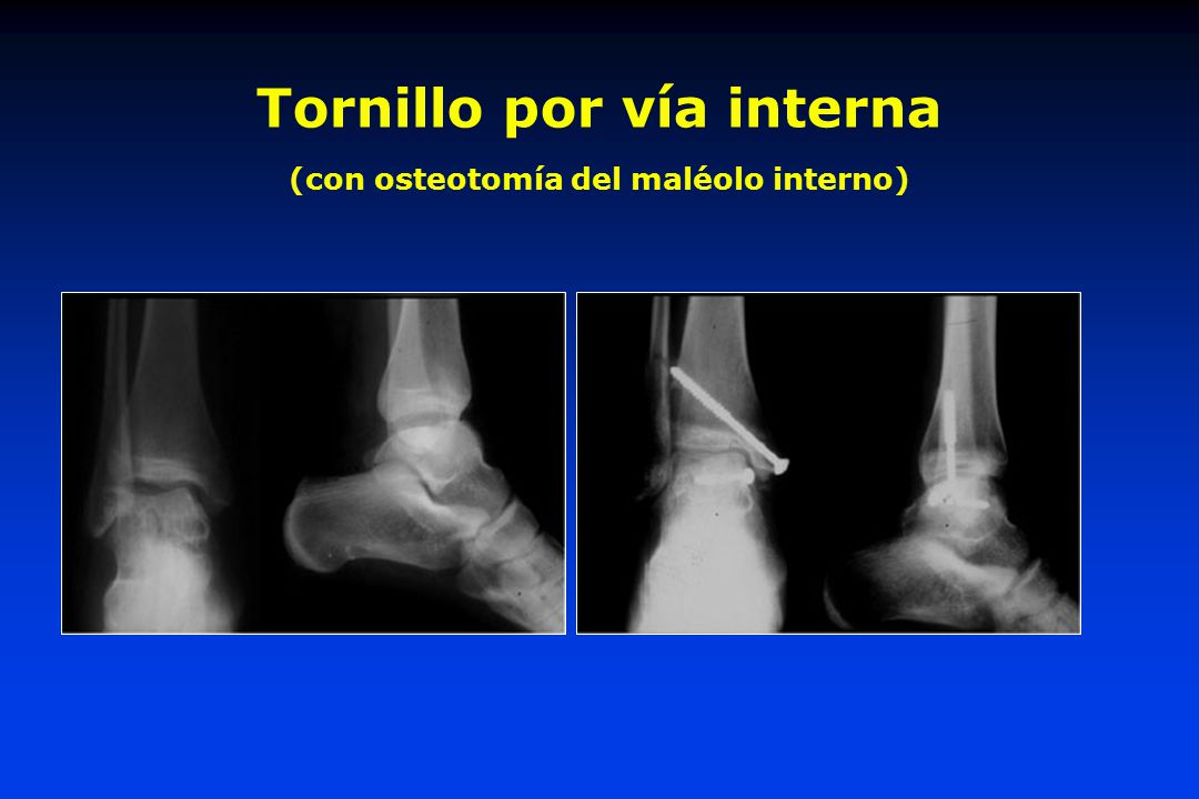 Tornillo por vía interna (con osteotomía del maléolo interno)