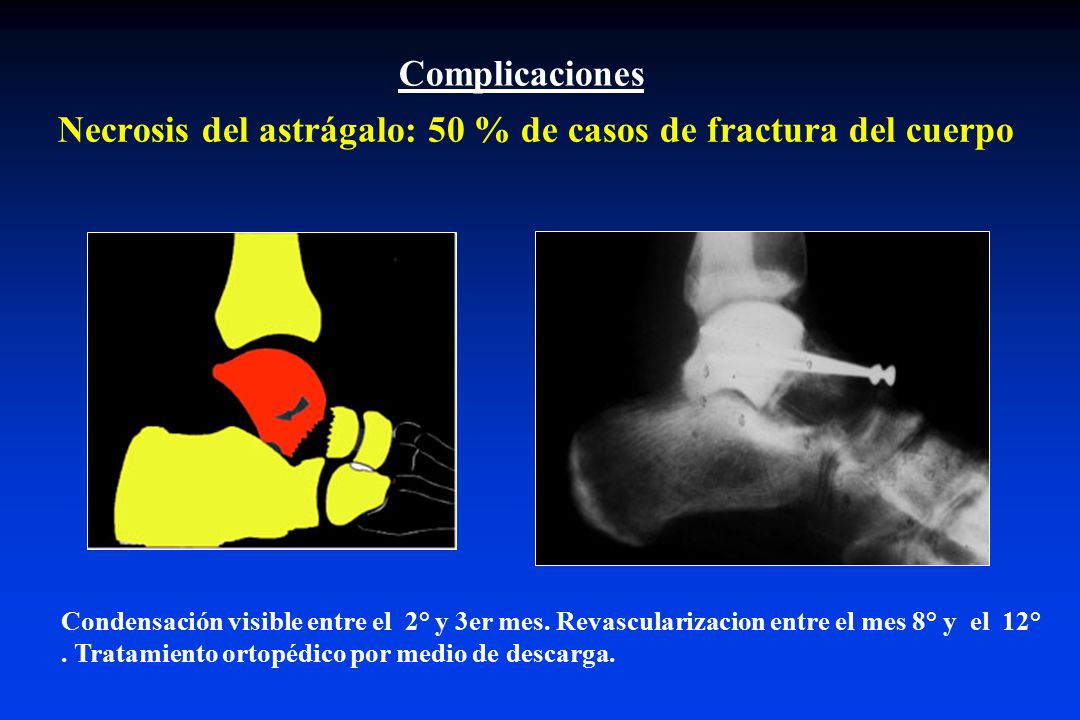 Necrosis del astrágalo: 50 % de casos de fractura del cuerpo