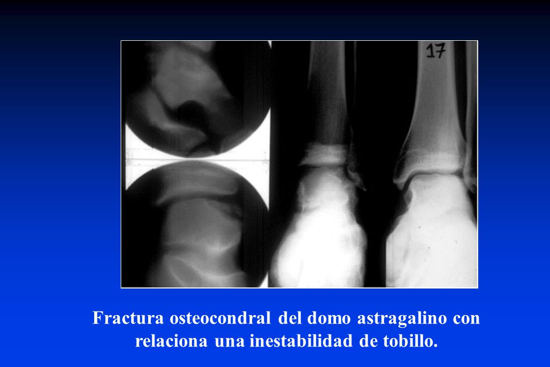 Fractura osteocondral del domo astragalino con relaciona una inestabilidad de tobillo.