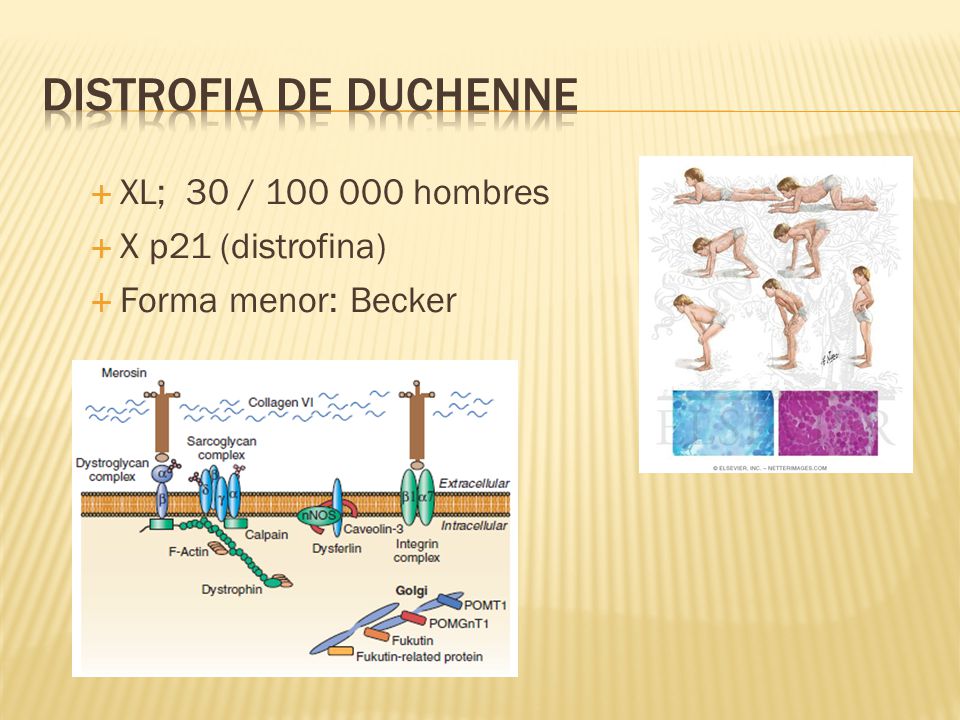 Distrofia de Duchenne XL; 30 / hombres X p21 (distrofina)