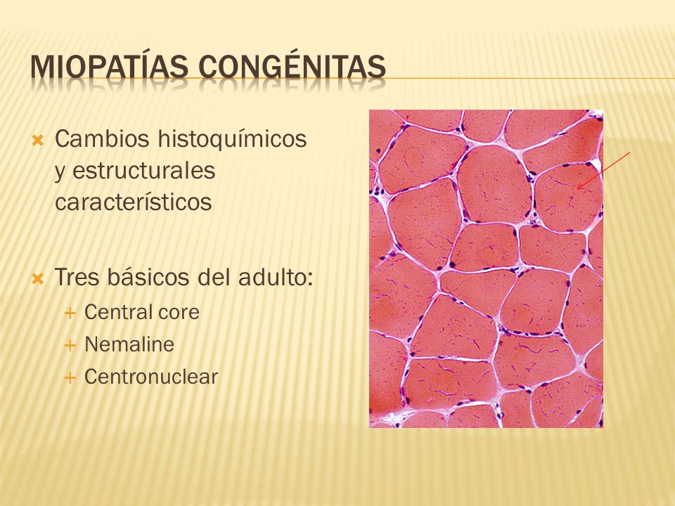 Miopatías congénitas Cambios histoquímicos y estructurales característicos. Tres básicos del adulto: