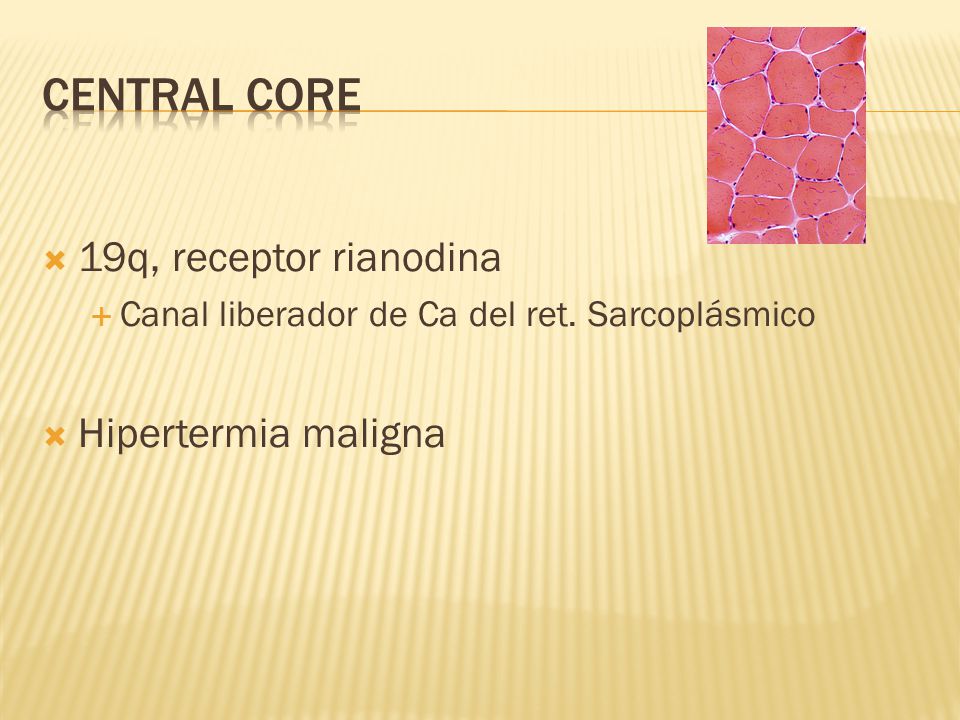 Central core 19q, receptor rianodina Hipertermia maligna