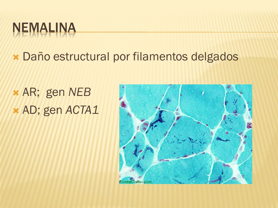 Nemalina Daño estructural por filamentos delgados AR; gen NEB