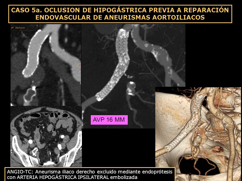 CASO 5a. OCLUSION DE HIPOGÁSTRICA PREVIA A REPARACIÓN ENDOVASCULAR DE ANEURISMAS AORTOILIACOS