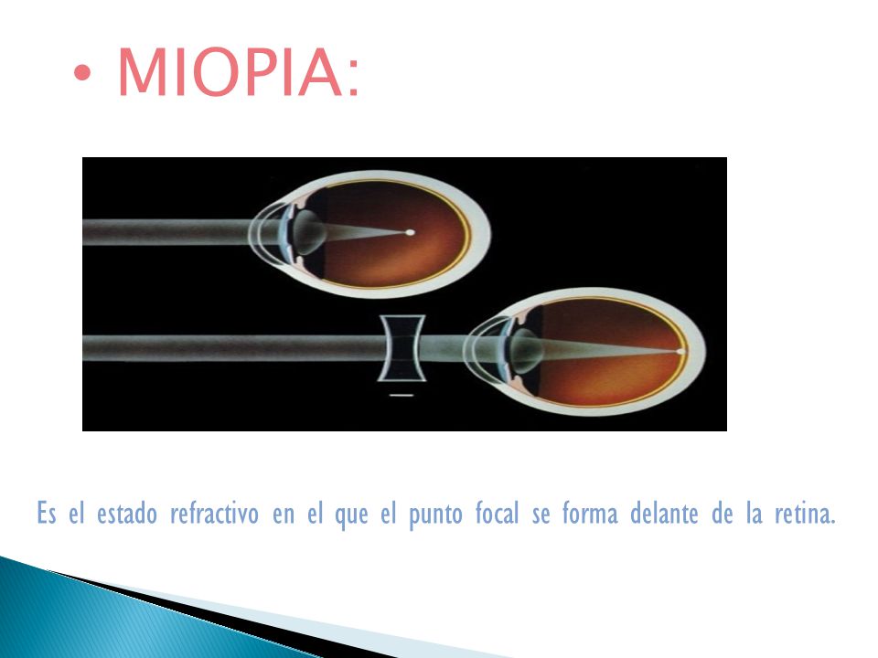 MIOPIA: Es el estado refractivo en el que el punto focal se forma delante de la retina.