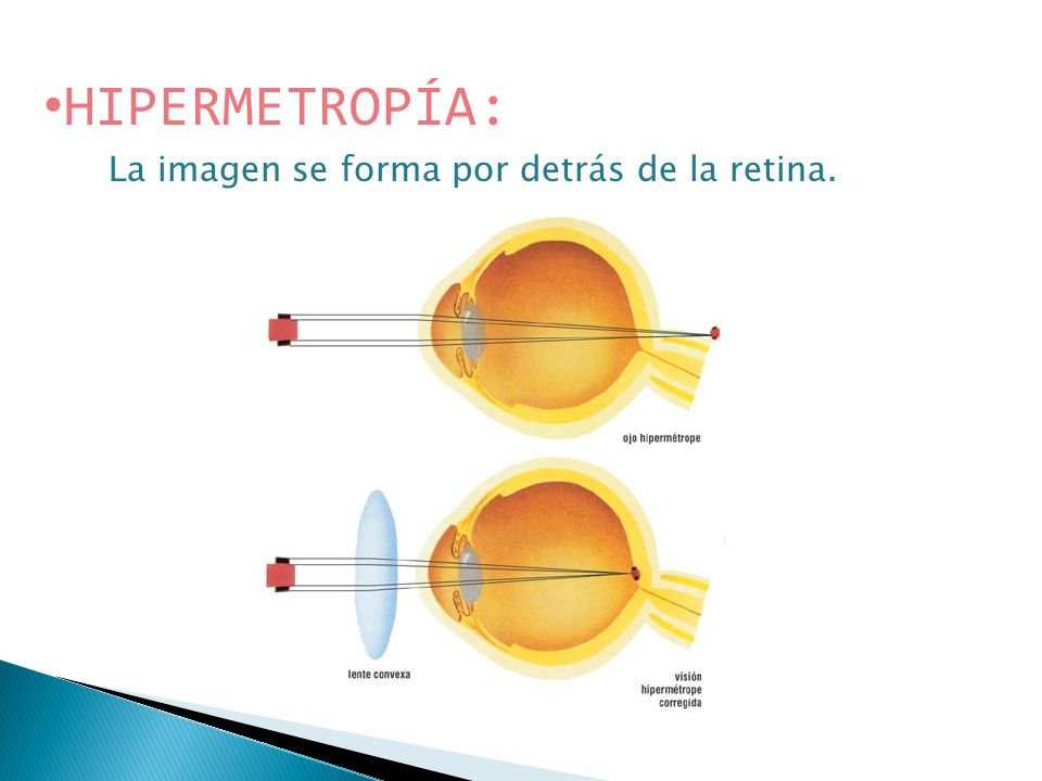 HIPERMETROPÍA: La imagen se forma por detrás de la retina.