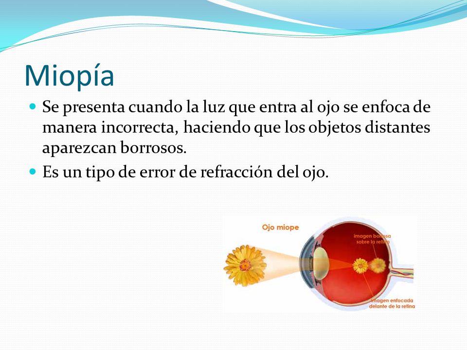 Miopía Se presenta cuando la luz que entra al ojo se enfoca de manera incorrecta, haciendo que los objetos distantes aparezcan borrosos.