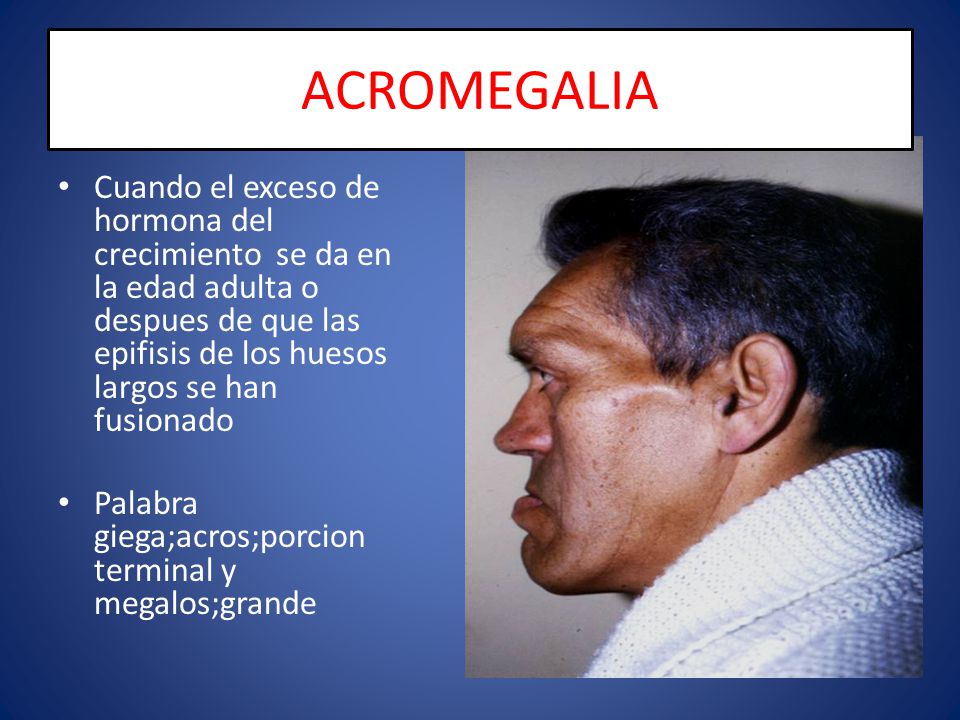 ACROMEGALIA Cuando el exceso de hormona del crecimiento se da en la edad adulta o despues de que las epifisis de los huesos largos se han fusionado.