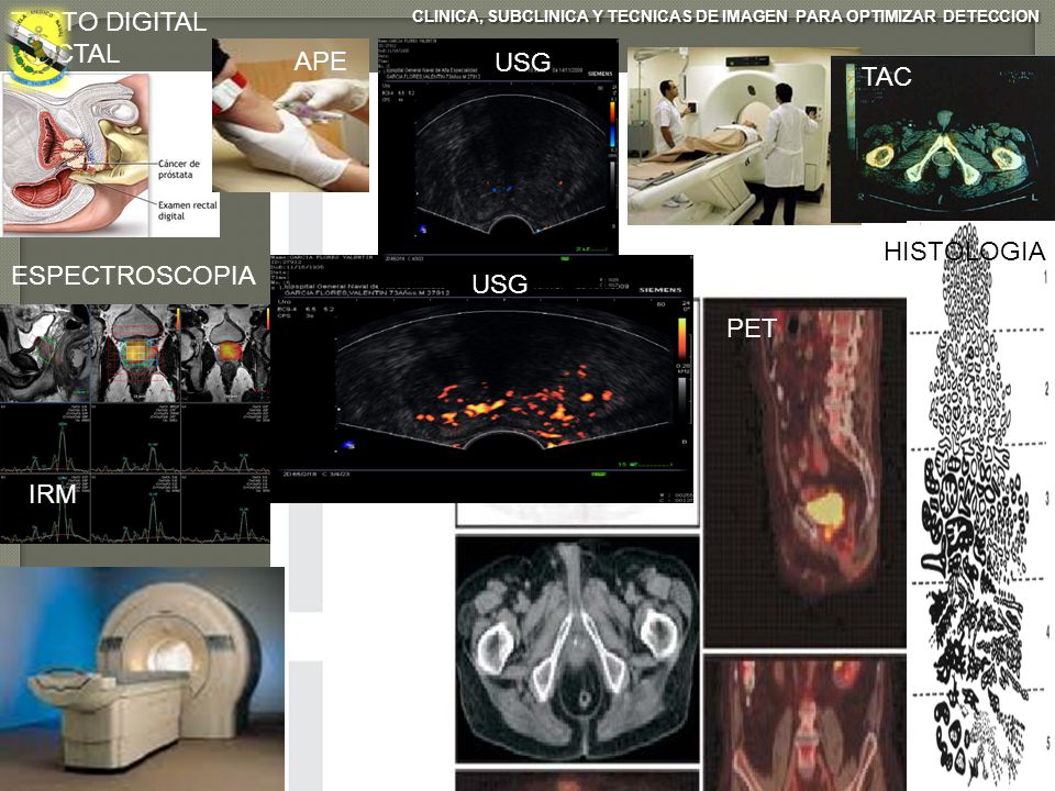 TACTO DIGITAL RECTAL APE USG TAC HISTOLOGIA ESPECTROSCOPIA USG PET IRM