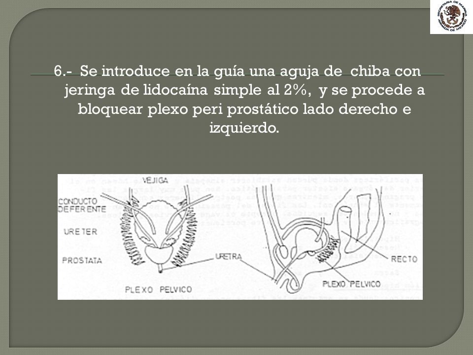 6.- Se introduce en la guía una aguja de chiba con jeringa de lidocaína simple al 2%, y se procede a bloquear plexo peri prostático lado derecho e izquierdo.