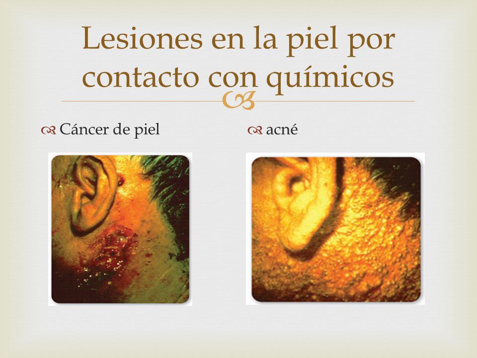 Lesiones en la piel por contacto con químicos