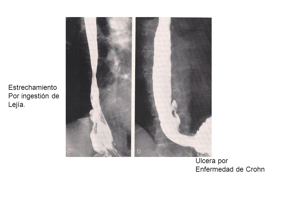 Estrechamiento Por ingestión de Lejía. Ulcera por Enfermedad de Crohn