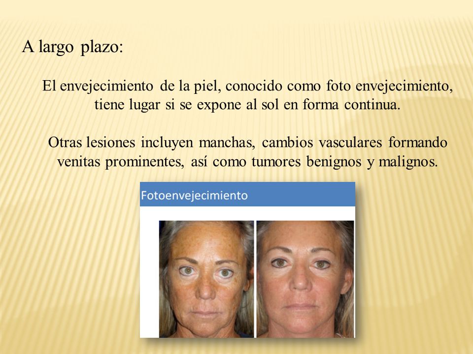 A largo plazo: El envejecimiento de la piel, conocido como foto envejecimiento, tiene lugar si se expone al sol en forma continua.